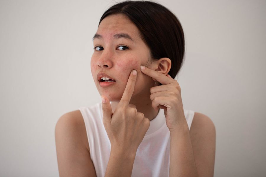 Giai đoạn dậy thì có thể khiến tuyến bã nhờn hoạt động quá mức làm hình thành mụn trứng cá Giai đoạn dậy thì có thể khiến tuyến bã nhờn hoạt động quá mức làm hình thành mụn trứng cá