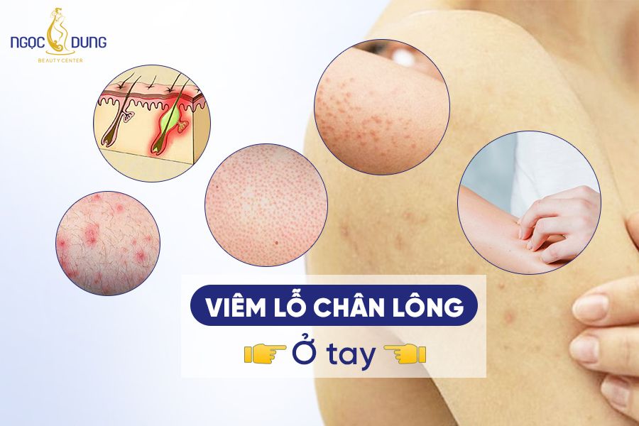 Viêm lỗ chân lông ở tay? Cách chữa viêm lỗ chân lông ở tay