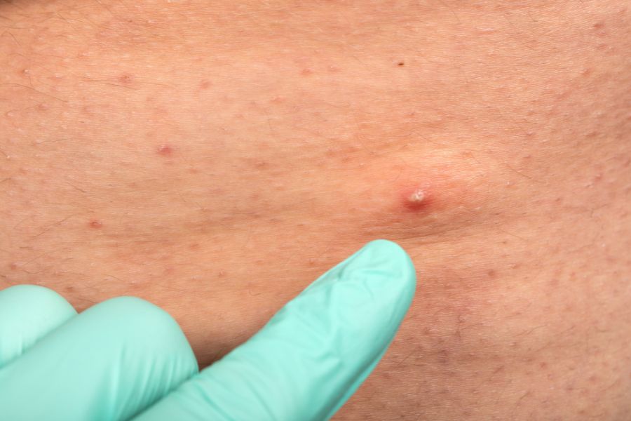 Một số nguyên nhân gây hình thành bệnh lý bắp tay nguyên nhân gây sưng tấy nang da