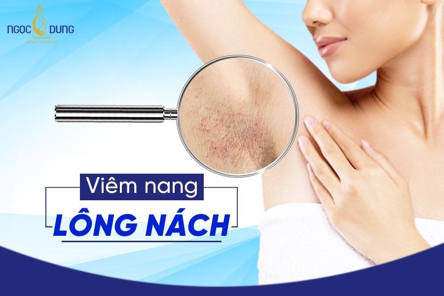 Viêm nang lông nách dù không gây nguy hiểm đến sức khỏe nhưng ảnh hưởng rất lớn đến thẩm mỹ