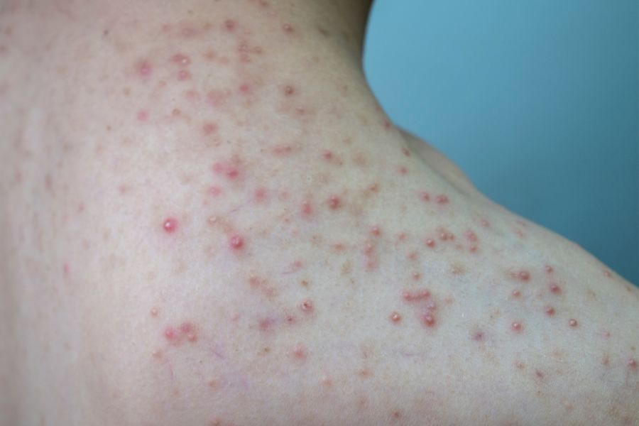 Các triệu chứng của sưng nang lông cánh tay Dấu hiệu nhận biết bệnh lý da tay