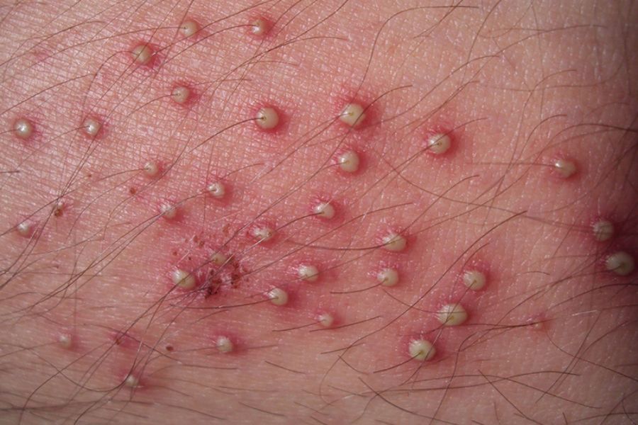 Triệu chứng và dấu hiệu viêm lỗ chân lông ở vùng kín