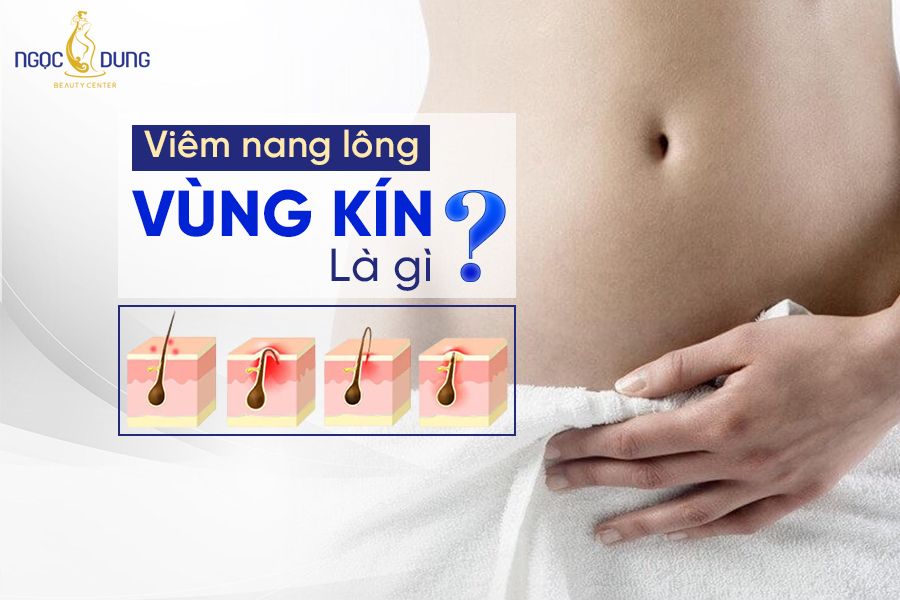 Nguyên nhân bị viêm nang lông vùng kín là gì? Bật mí cách điều trị triệt để