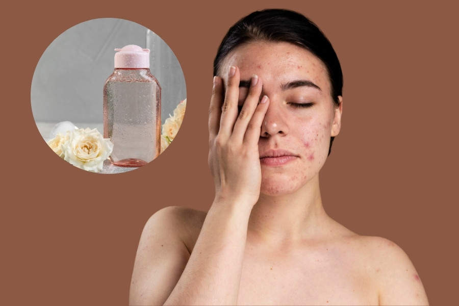 Da mụn nên chọn nước hoa hồng chứa các loại axit như AHA hoặc BHA