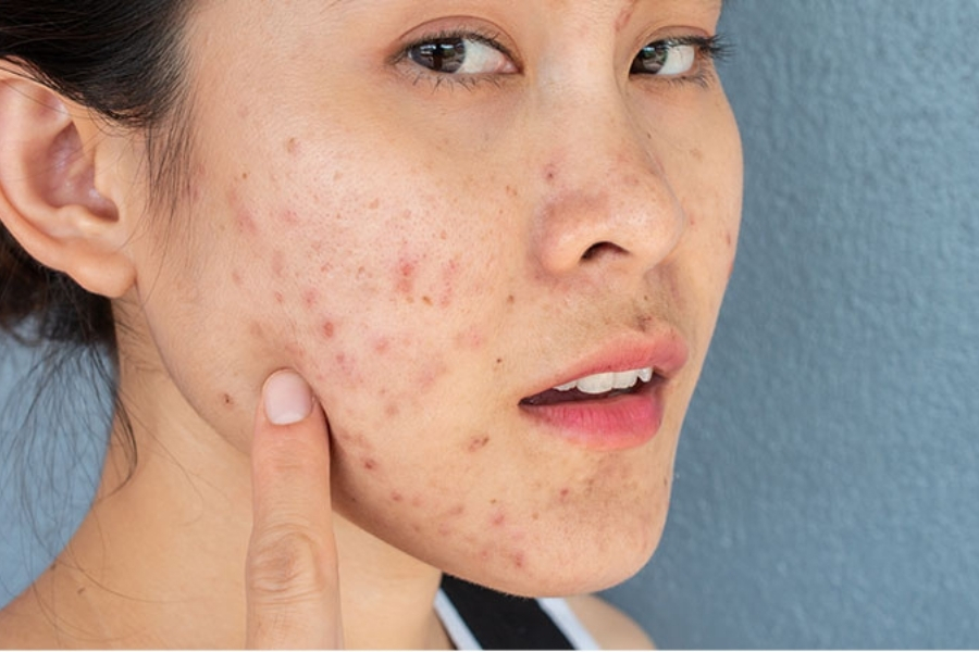 Benzoyl Peroxide có trị thâm không? Benzoyl Peroxide có trị thâm không?