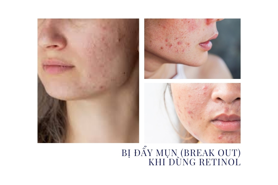Bị đẩy mụn khi sử dụng Retinol có thể là dấu hiệu cho thấy da bị dị ứng