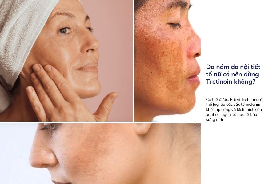 Bị nám nội tiết có thể dùng Tretinoin được không?
