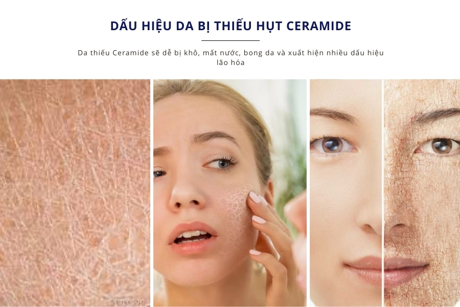Ceramide là gì? Da sẽ như thế nào nếu bị thiếu hụt Ceramide? Ceramide là gì? Da sẽ như thế nào nếu bị thiếu hụt Ceramide?