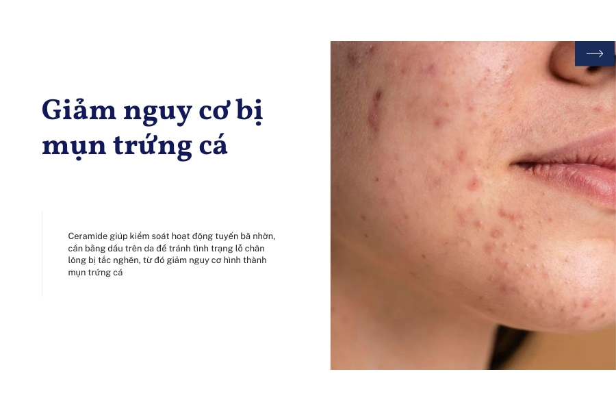Ceramide có tác dụng gì đối với da mụn trứng cá? Ceramide có tác dụng gì đối với da mụn trứng cá?