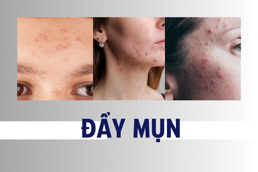 Mandelic Acid có đẩy mụn không?