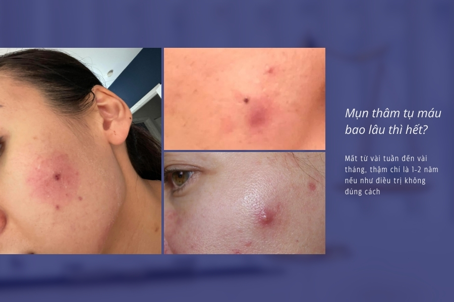 Mụn thâm tụ máu bao lâu thì hết? Mụn thâm tụ máu bao lâu thì hết?