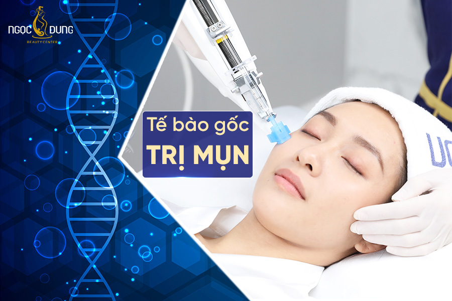 Phương pháp dùng tế bào gốc trị mụn là gì? Có hiệu quả hay không?