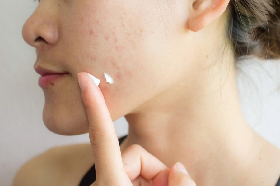 Thay thế Benzoyl Peroxide trị mụn bằng Adapalene Thay thế Benzoyl Peroxide trị mụn bằng Adapalene