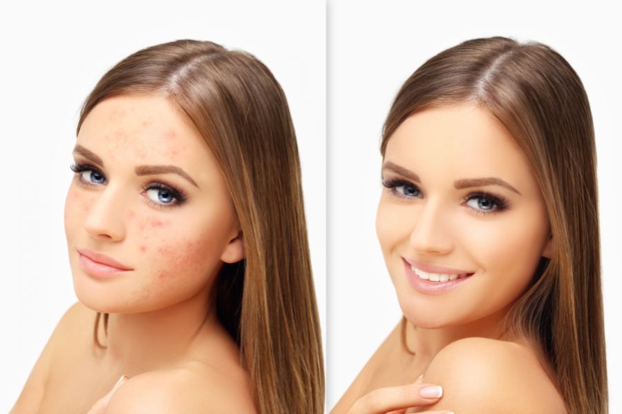 Dưỡng chất trong bơ hỗ trợ giảm mụn