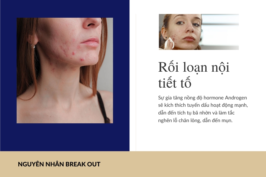Rối loạn nội tiết tố là một trong khiến da bị break out nghiêm trọng