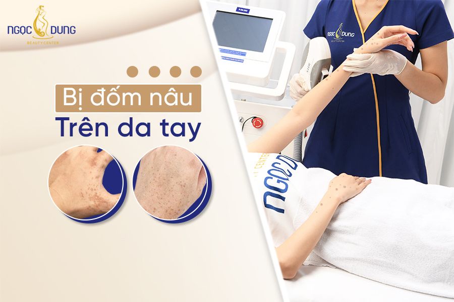Nguyên nhân và cách điều trị tình trạng bị đốm nâu trên da tay hiệu quả cho chị em