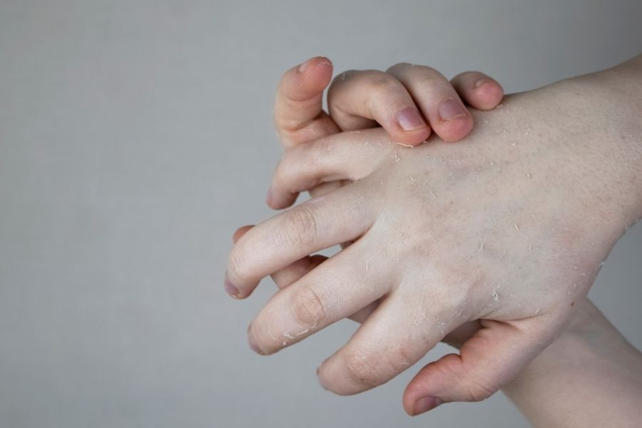 Bị tróc da tay do thiếu vitamin C