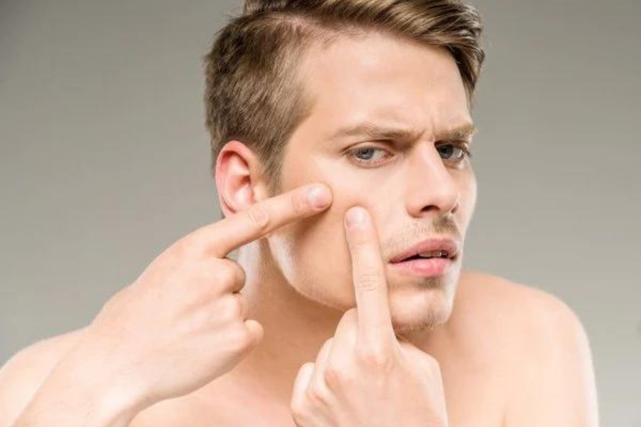 Mụn nội tiết có nên nặn không? Mụn nội tiết có nên nặn không?