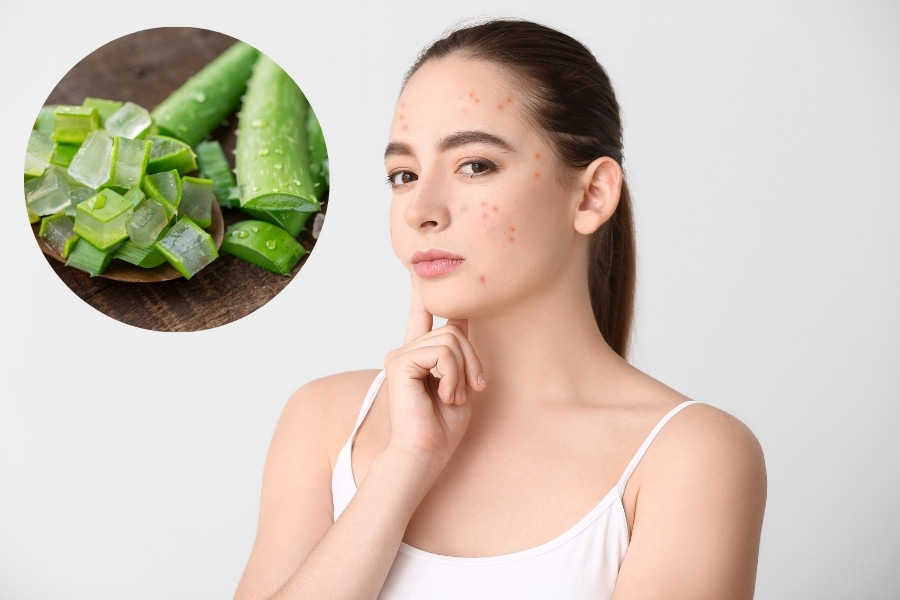 Da bị mụn mủ, mụn viêm nên tránh dùng nha đam