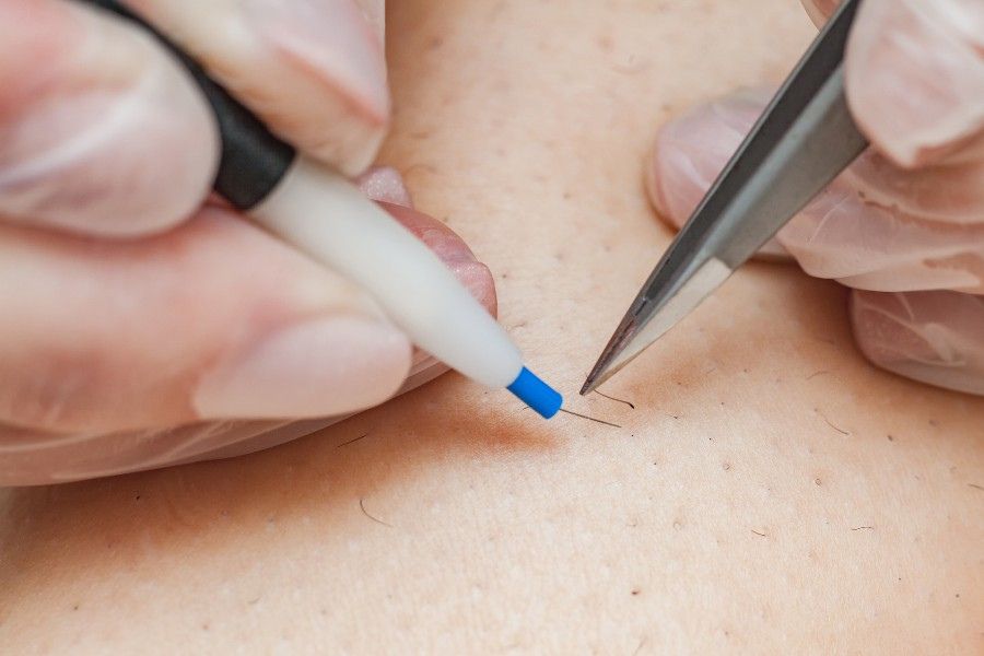 Triệt lông vùng kín bằng phương pháp điện phân