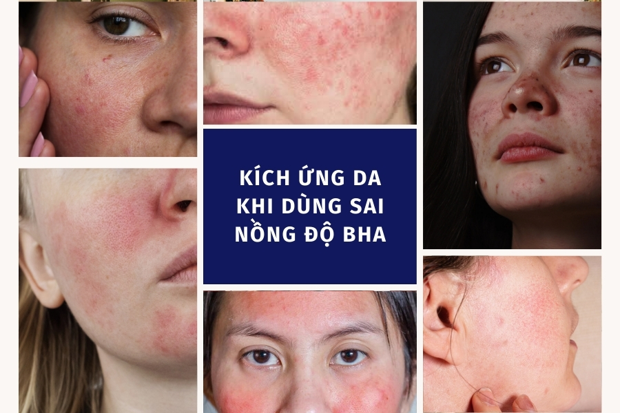 Dùng sai nồng độ BHA có thể làm da bị kích ứng, nhạy cảm hơn