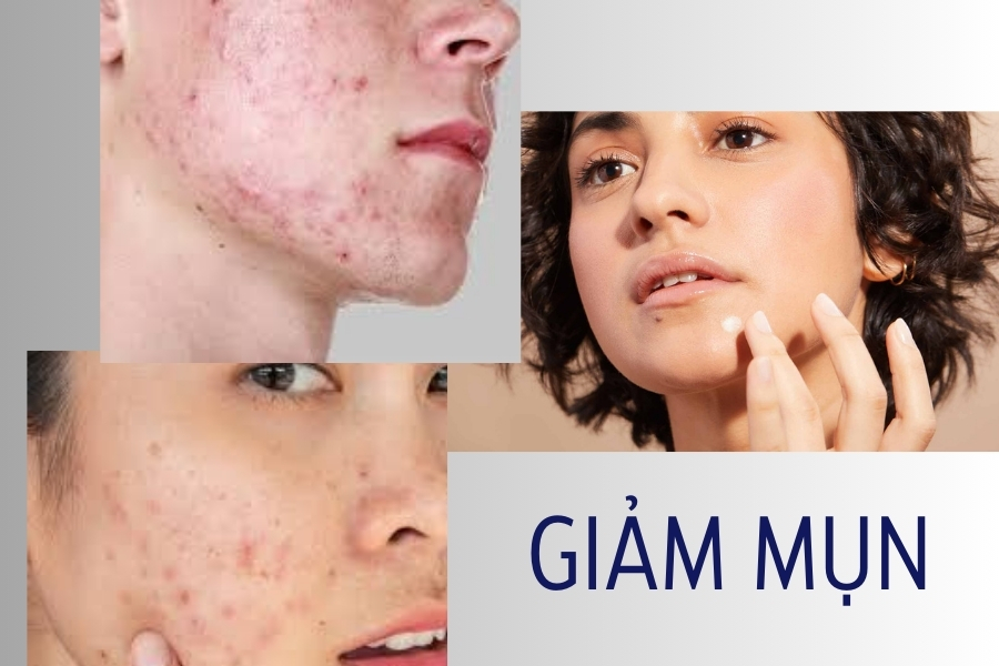 Dùng Mandelic Acid để giảm mụn ẩn, mụn trứng cá