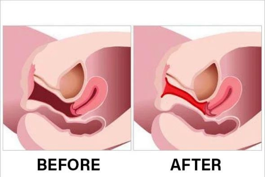 Sự thay đổi sau khi trẻ hóa âm đạo bằng công nghệ cao