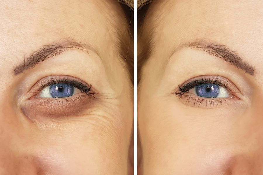 Bôi dầu oliu lên vùng mắt giúp giảm quầng thâm Bôi dầu oliu lên vùng mắt giúp giảm quầng thâm