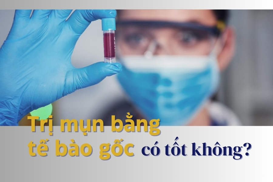 Trị mụn bằng tế bào gốc có thực sự tốt không? Trị mụn bằng tế bào gốc có thực sự tốt không?