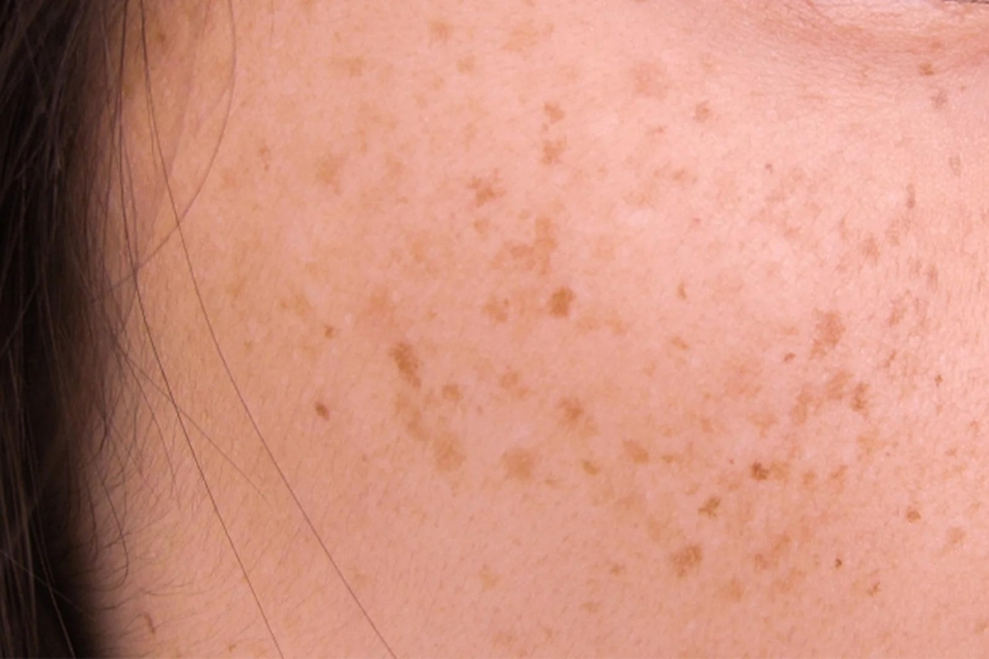 Nổi đốm nâu trên da có xấu không?