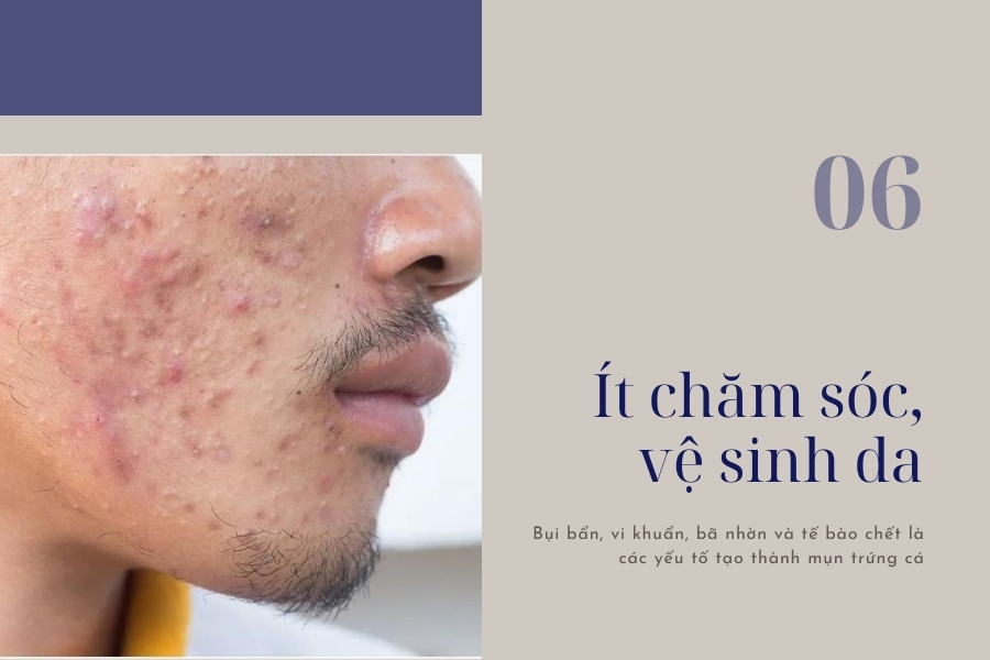 Không vệ sinh da mặt sạch sẽ là lý do khiến mụn phát triển nhiều hơn Không vệ sinh da mặt sạch sẽ là lý do khiến mụn phát triển nhiều hơn