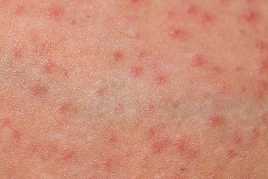 cao long nach co anh huong gi khong