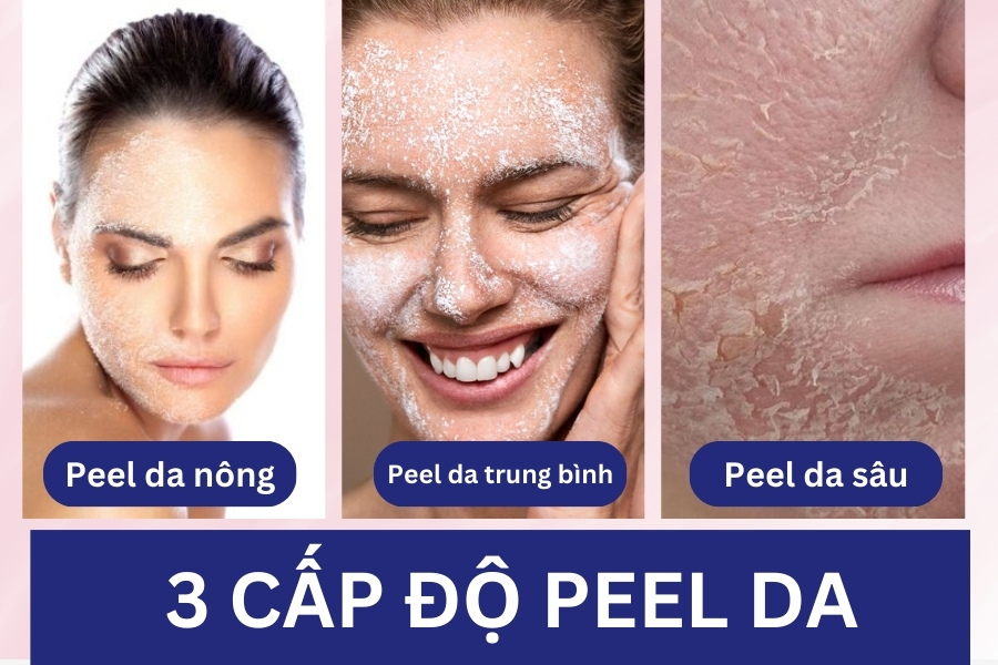 Peel da có 3 cấp độ từ nông - trung bình - sâu
