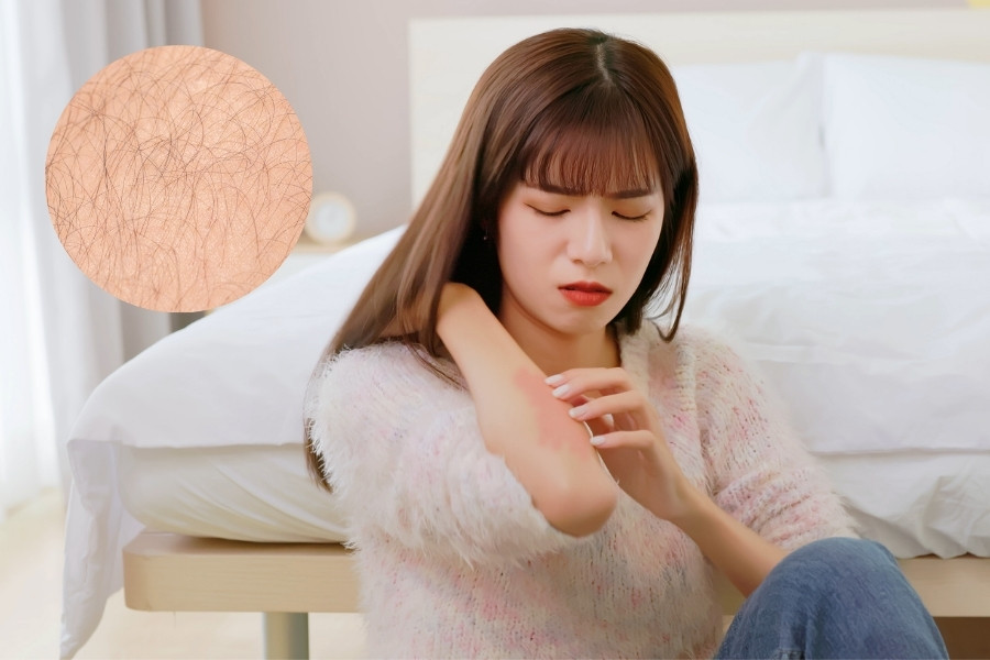 Hội chứng cushing là một trong những nguyên nhân khiến con gái lông tay nhiều Lông tay mọc nhiều do Hội chứng cushing