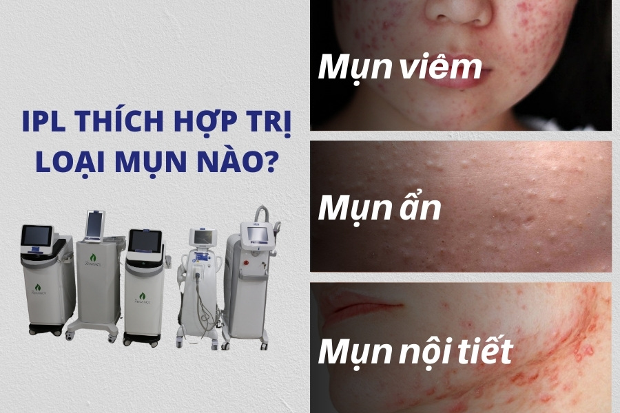 Công nghệ IPL có thể dùng để điều trị nhiều loại mụn khác nhau