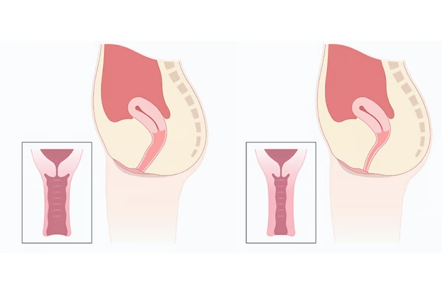 Cô bé bị rộng, có cảm giác đau khi quan hệ thì nên thực hiện phương pháp trẻ hóa để cải thiện