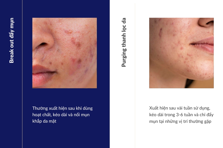 Làm sao phân biệt giữa đẩy mụn và break out?