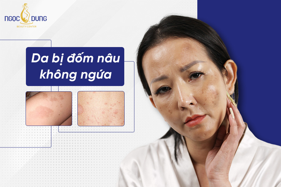 Da nổi đốm nâu không ngứa là do đâu? Cách điều trị hiệu quả