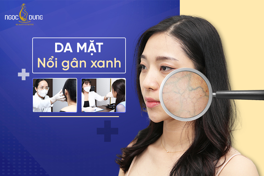 da mặt nổi gân xanh