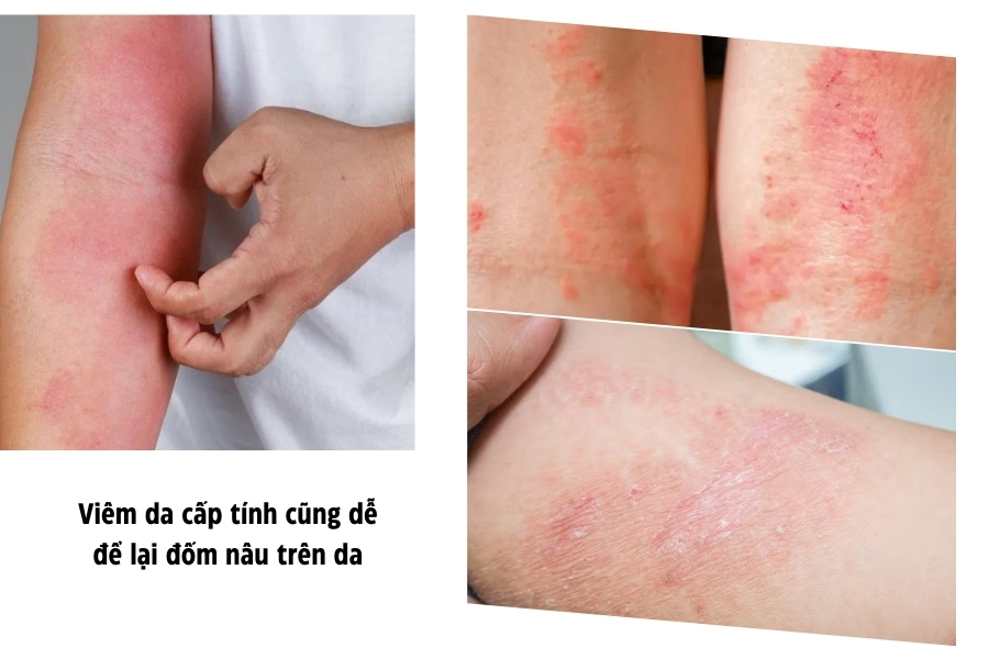 Viêm da cấp tính có thể để lại đốm nâu