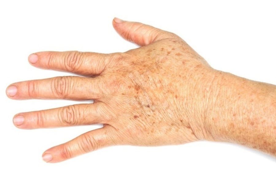 Tay bị đốm nâu là tình trạng gia tăng sắc tố melanin do tiếp xúc với tia UV