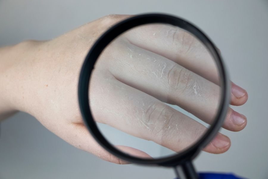 Tình trạng tróc da tay có thể do thiếu vitamin B3