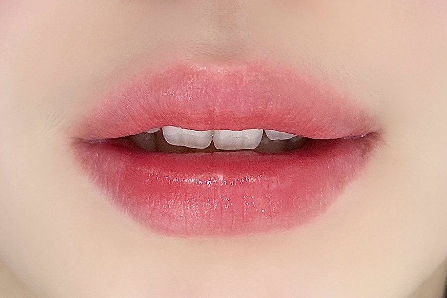 Dịch vụ khử thâm môi chỉ tác động trên bề mặt da, không xâm lấn, không kiêng cữ