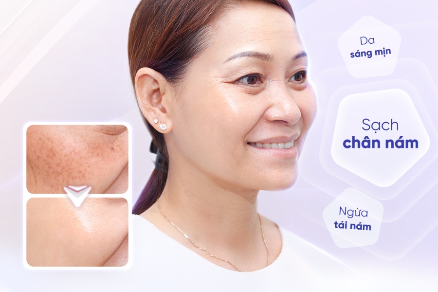 Điều trị nám, tàn nhang chuyên sâu tại TMV Ngọc Dung Điều trị nám, tàn nhang chuyên sâu tại TMV Ngọc Dung