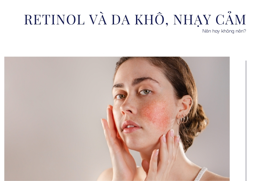 Da khô nhạy cảm có nên dùng Retinol không?