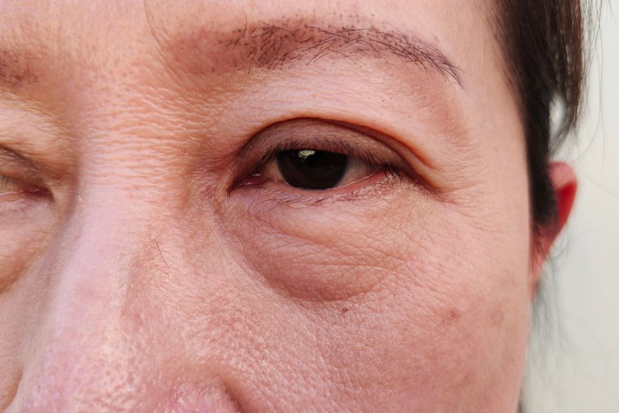 Có rất nhiều nguyên nhân khiến bọng mắt hình thành