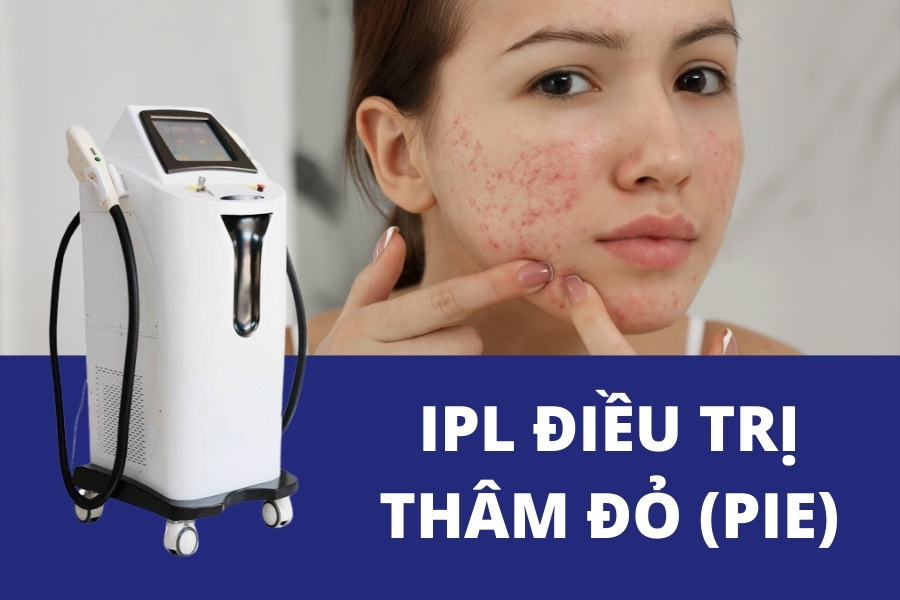 Không chỉ làm khô mụn mà IPL còn có tác dụng làm giảm thâm mụn đỏ