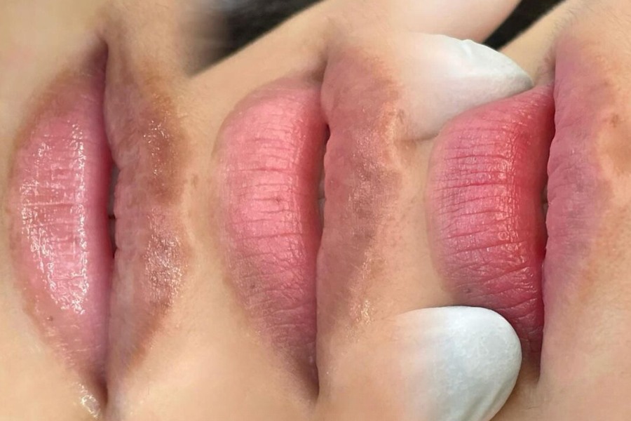 khử thâm môi có lên màu không