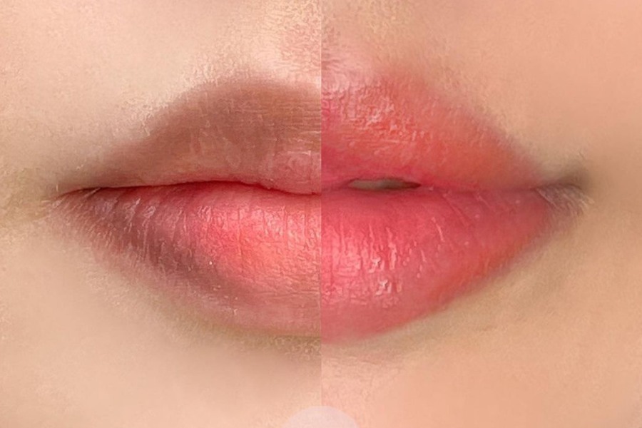 Khử thâm môi tại Ngọc Dung Beauty Center giải quyết dứt điểm các vấn đề thâm viền, thâm mép lâu năm