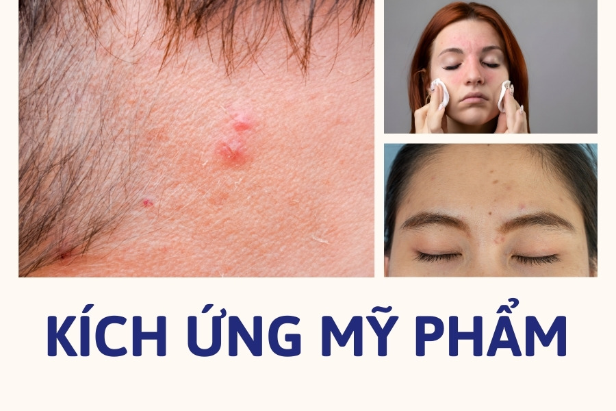 kich ung my pham gay mun boc o tran